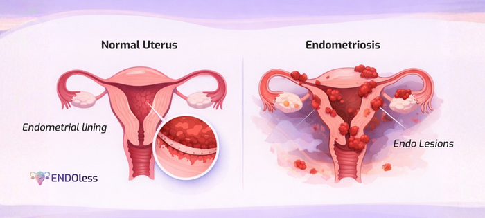Illustration showing endometriosis tissue growing outside the uterus, highlighting inflammation, scarring, and affected pelvic organs to explain how the disease develops in the body.